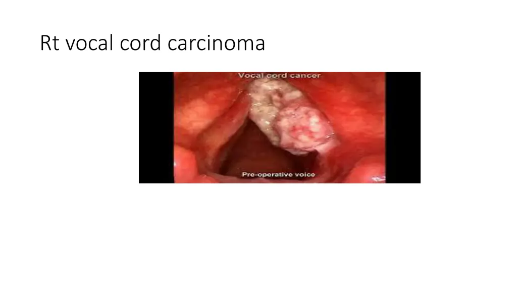 rt vocal cord carcinoma