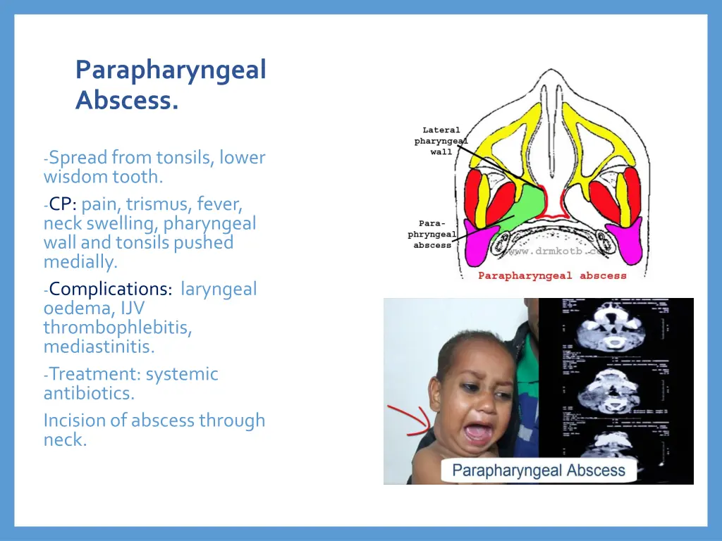 parapharyngeal abscess