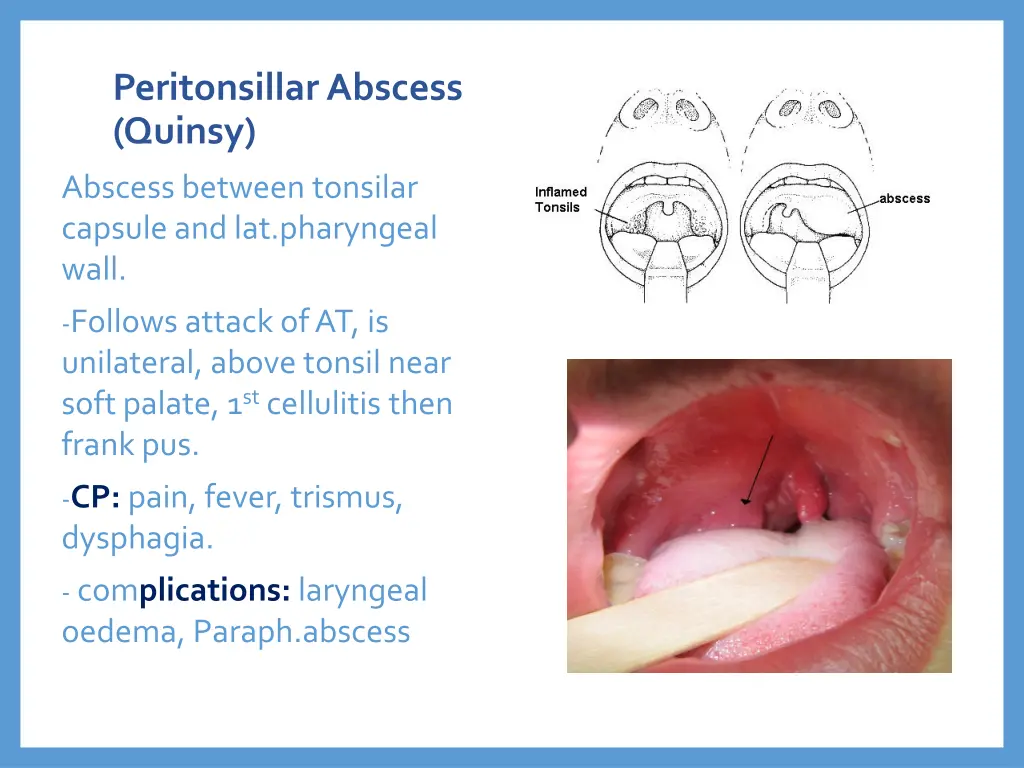 peritonsillarabscess quinsy