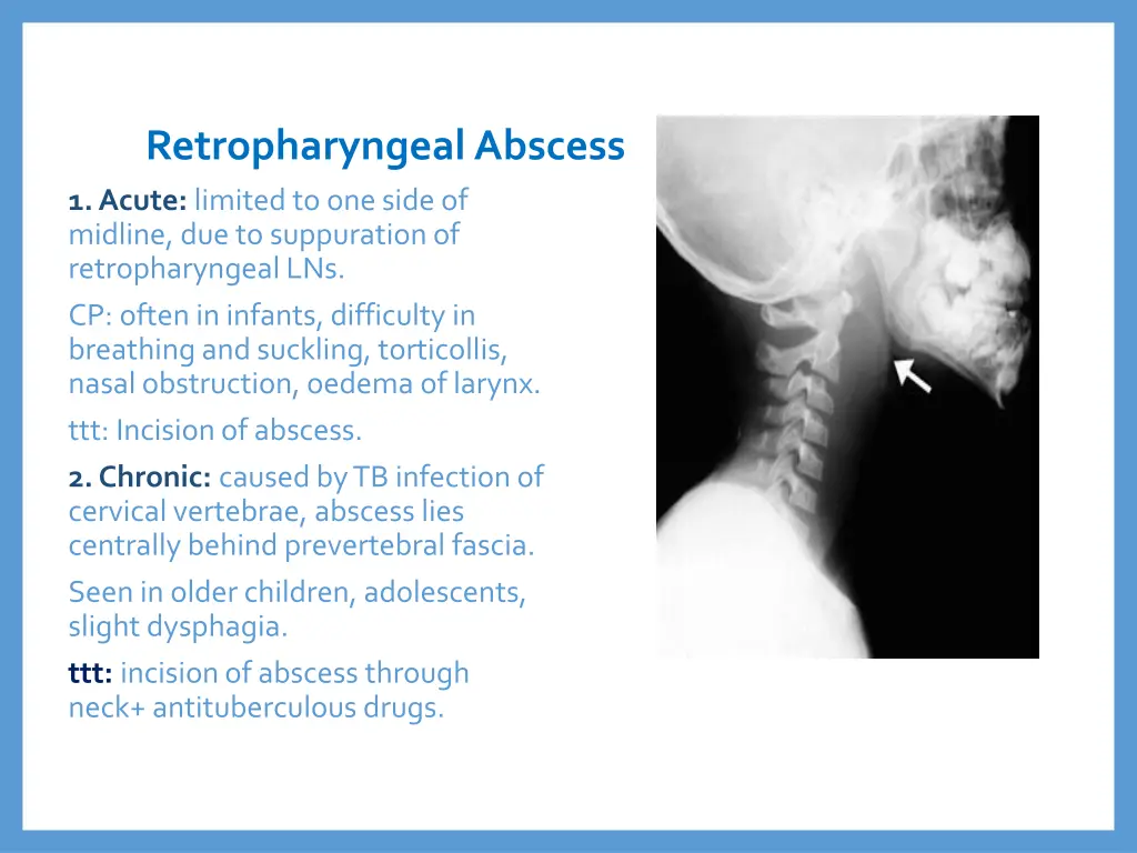 retropharyngeal abscess 1 acute limited