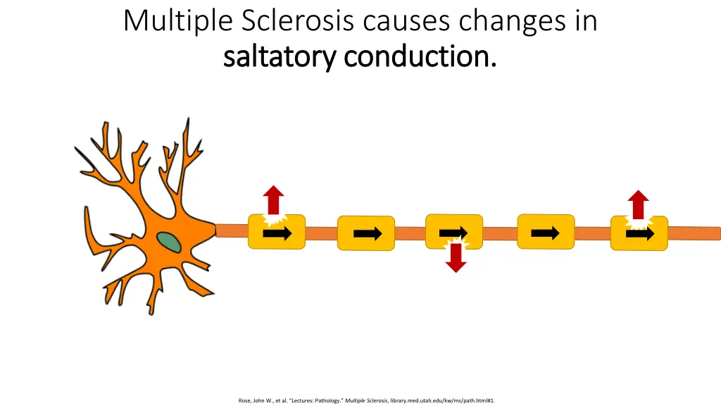 multiple sclerosis causes changes in saltatory