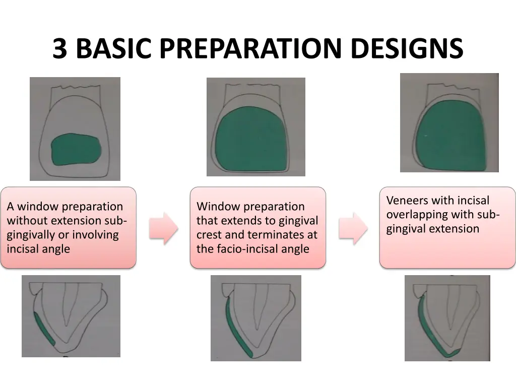 3 basic preparation designs