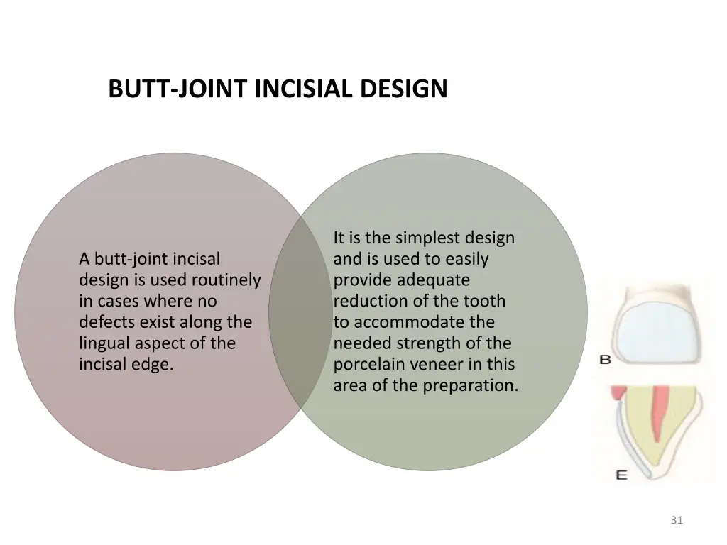 butt joint incisial design