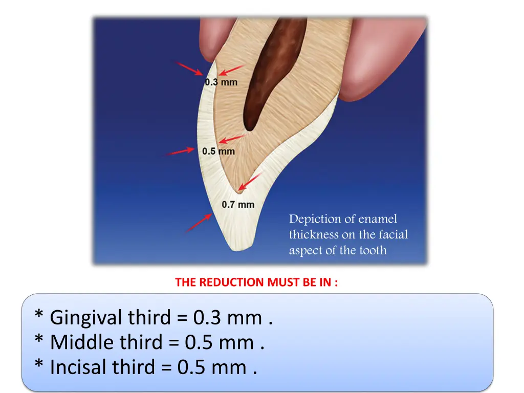 depiction of enamel thickness on the facial