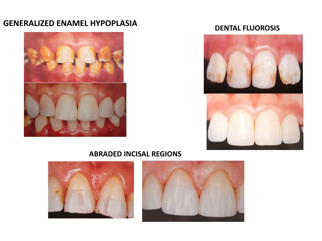 generalized enamel hypoplasia