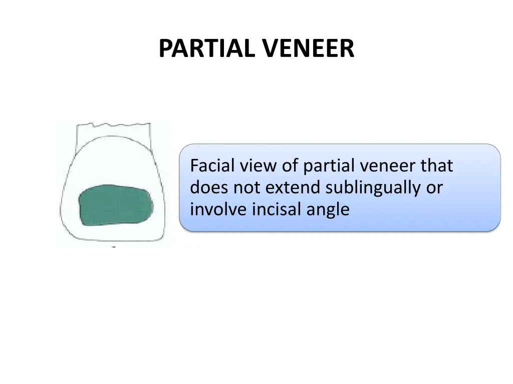 partial veneer