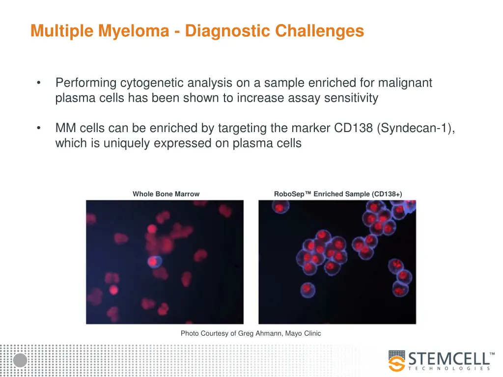 multiple myeloma diagnostic challenges 1