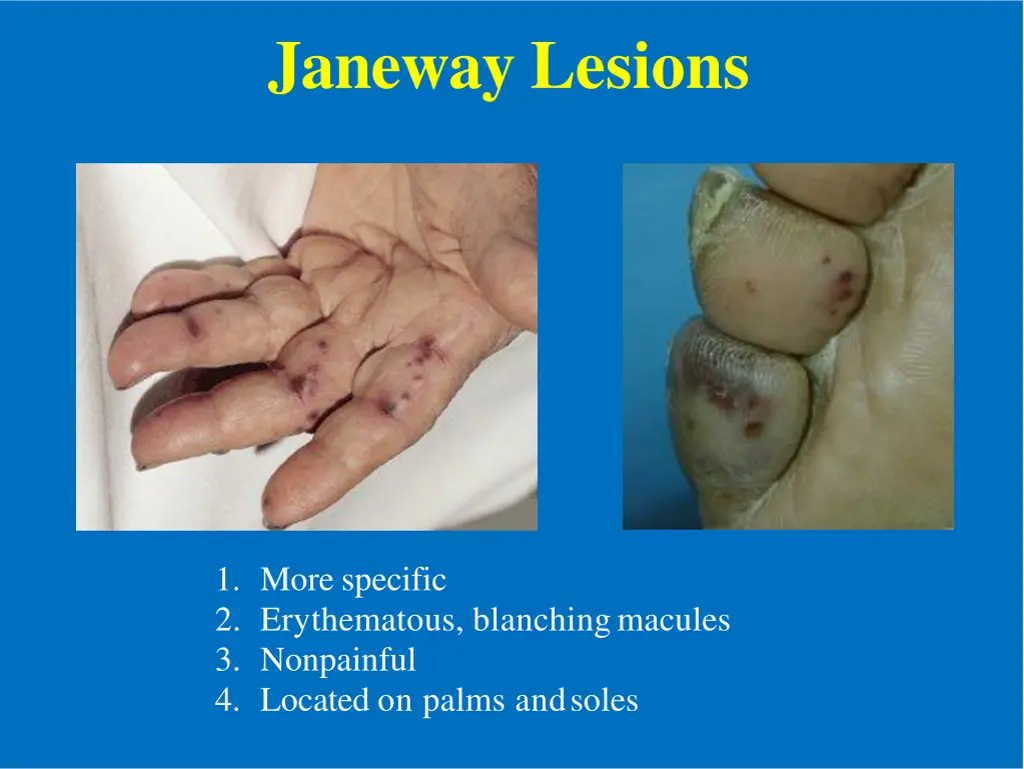 janeway lesions