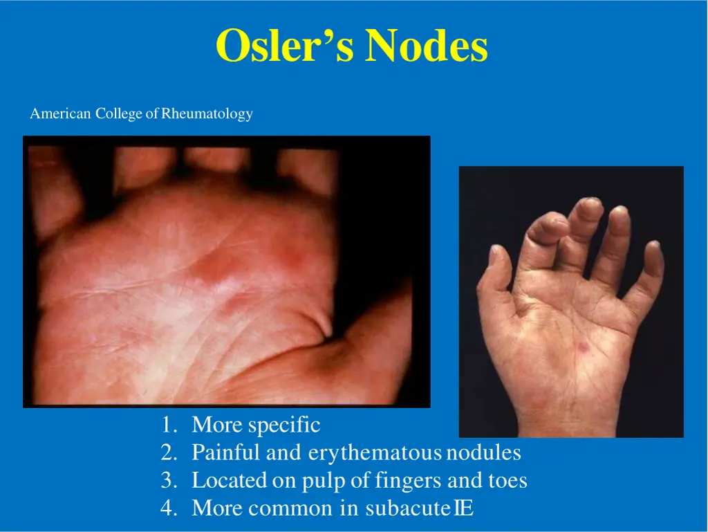 osler s nodes