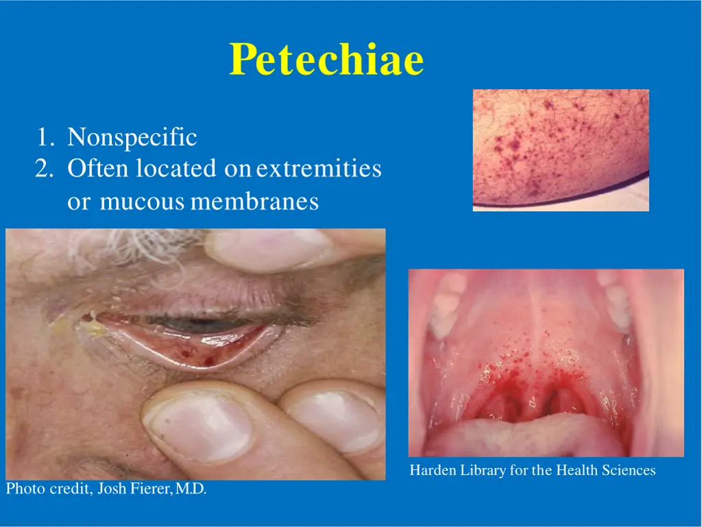 petechiae