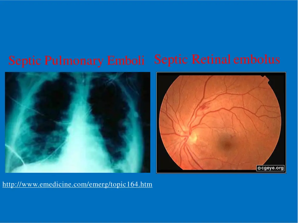 septic pulmonary emboli septic retinalembolus