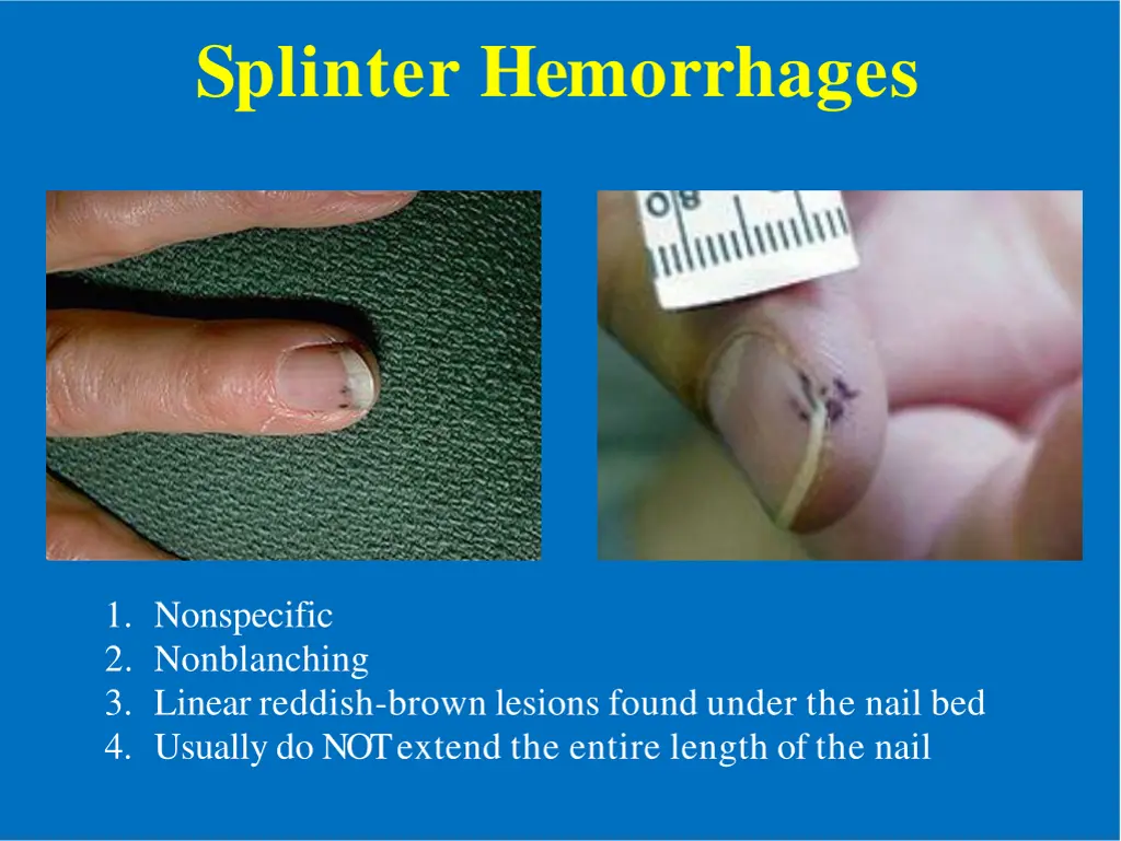 splinter hemorrhages