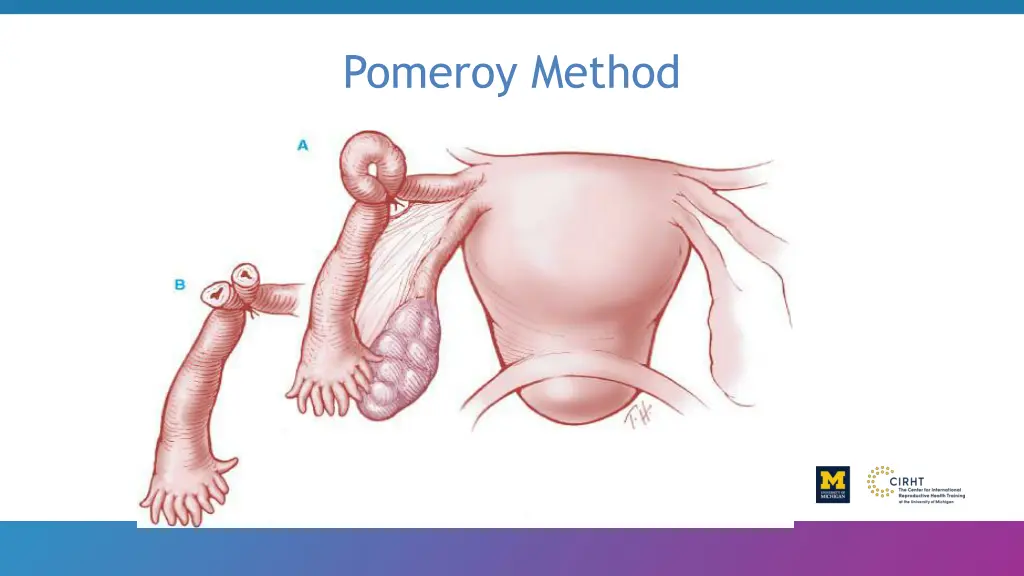 pomeroy method