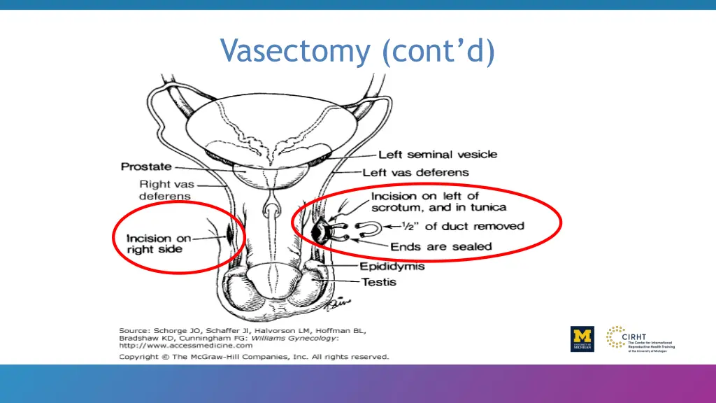 vasectomy cont d