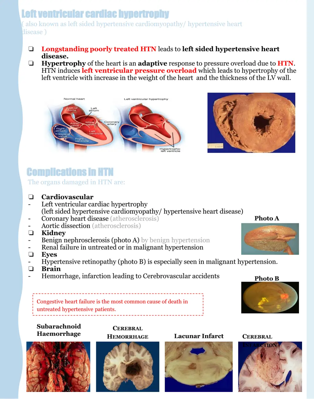 left ventricular cardiac hypertrophy left