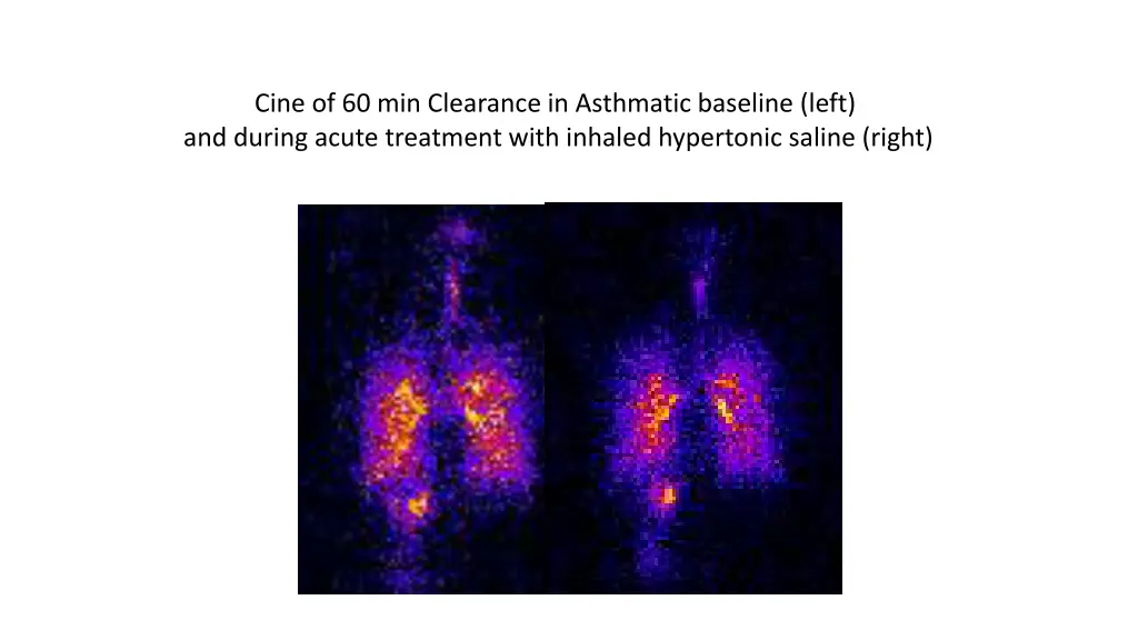 cine of 60 min clearance in asthmatic baseline