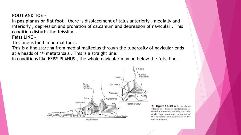 foot and toe in pes planus or flat foot there