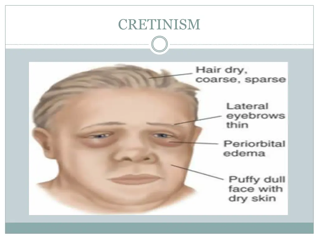 cretinism