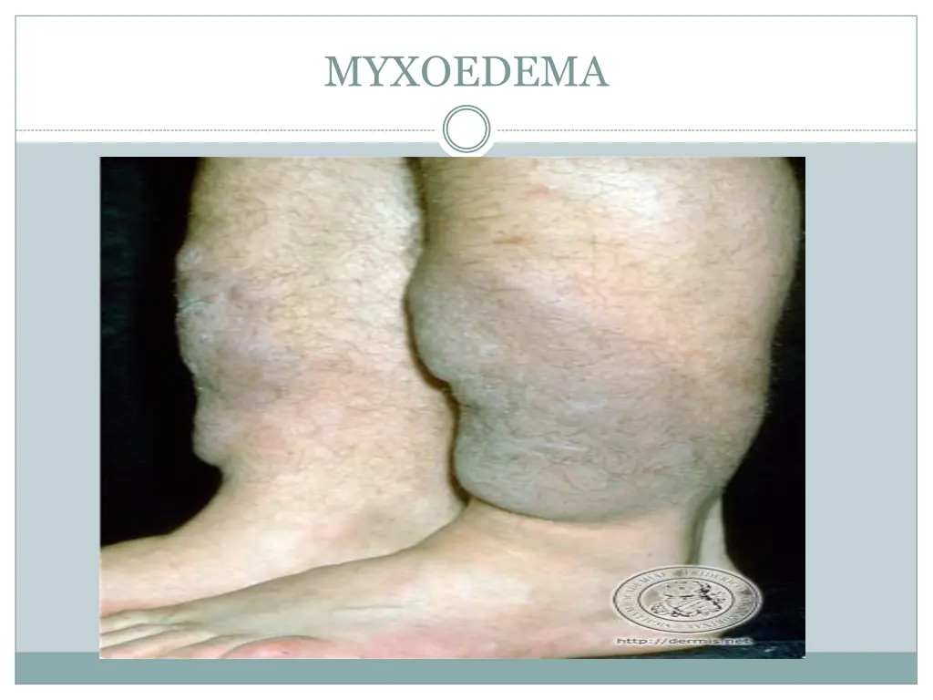 myxoedema