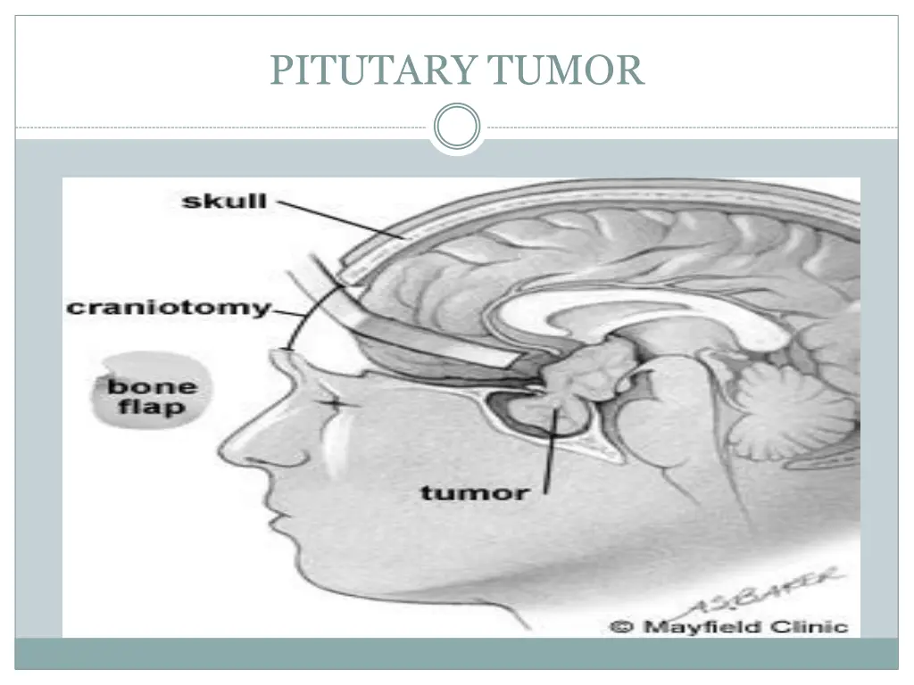 pitutary tumor