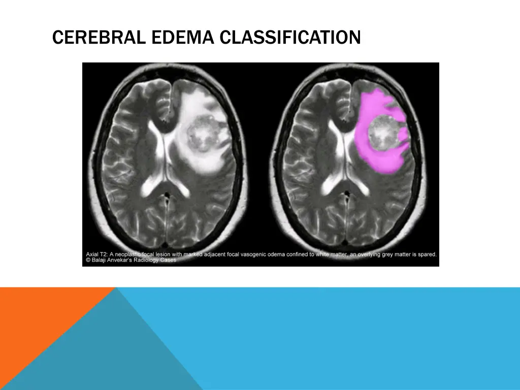 cerebral edema classification 2