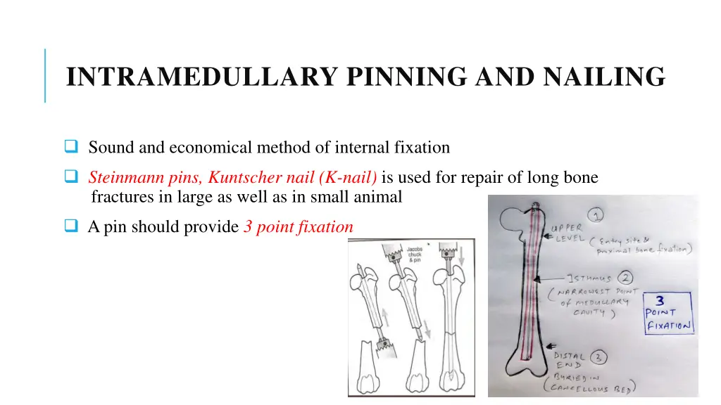 intramedullary pinning and nailing