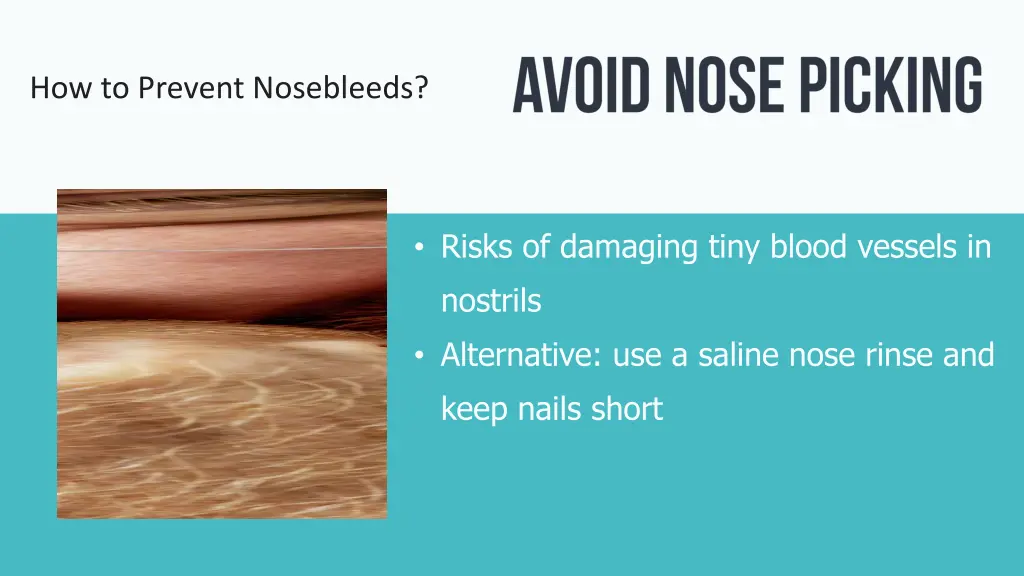 how to prevent nosebleeds 2