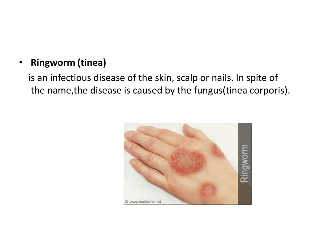 ringworm tinea is an infectious disease