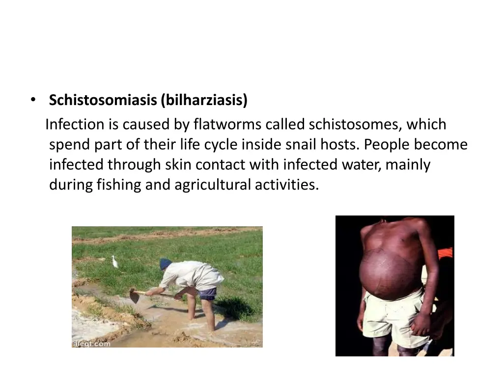 schistosomiasis bilharziasis infection is caused