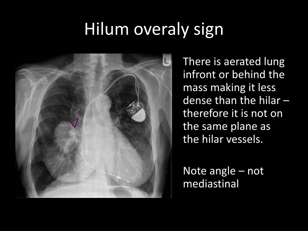 hilum overaly sign