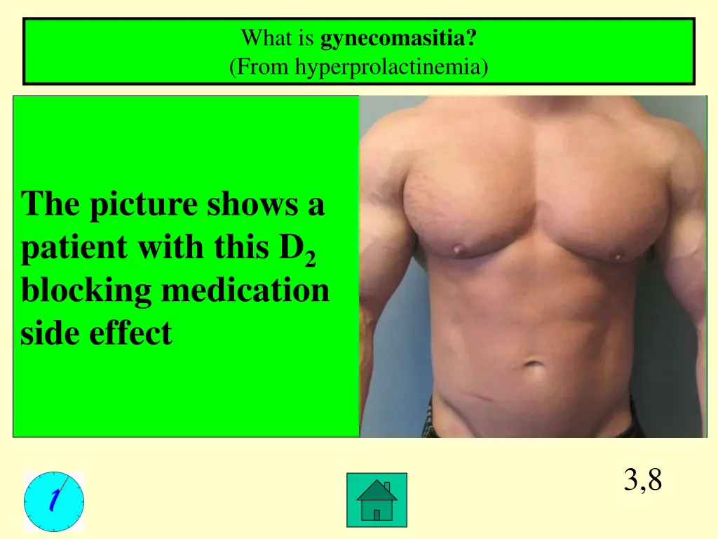 what is gynecomasitia from hyperprolactinemia