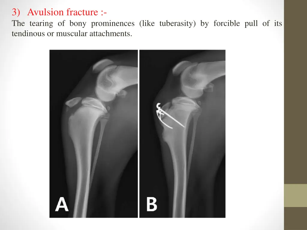 3 avulsion fracture the tearing of bony