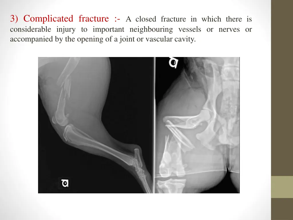 3 complicated fracture a closed fracture in which