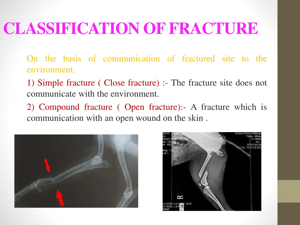 classification of fracture