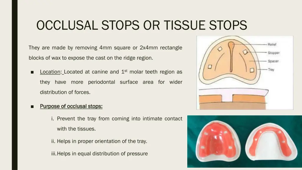 occlusal stops or tissue stops