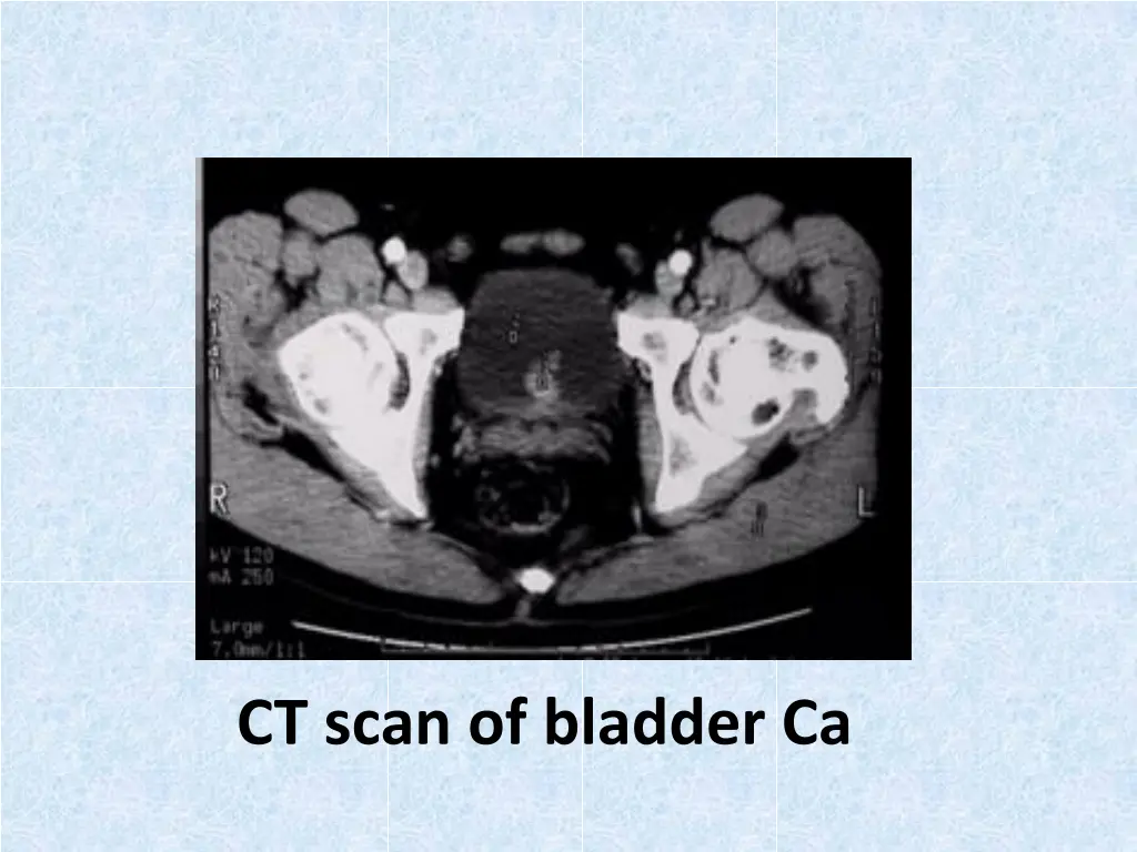 ct scan of bladder ca