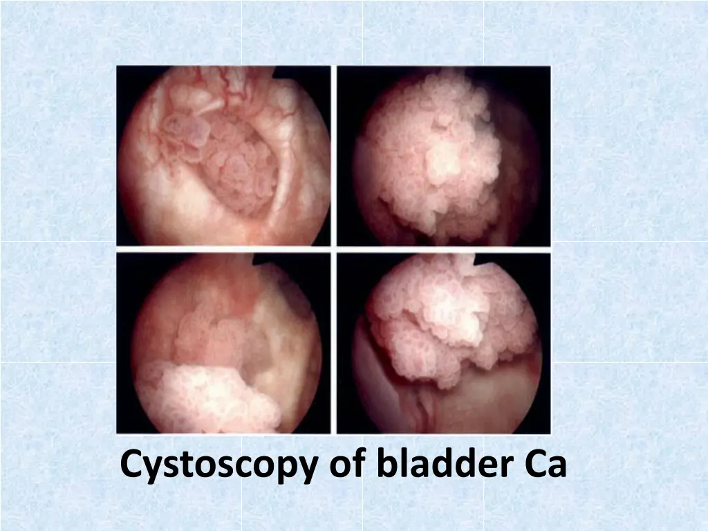 cystoscopy of bladder ca