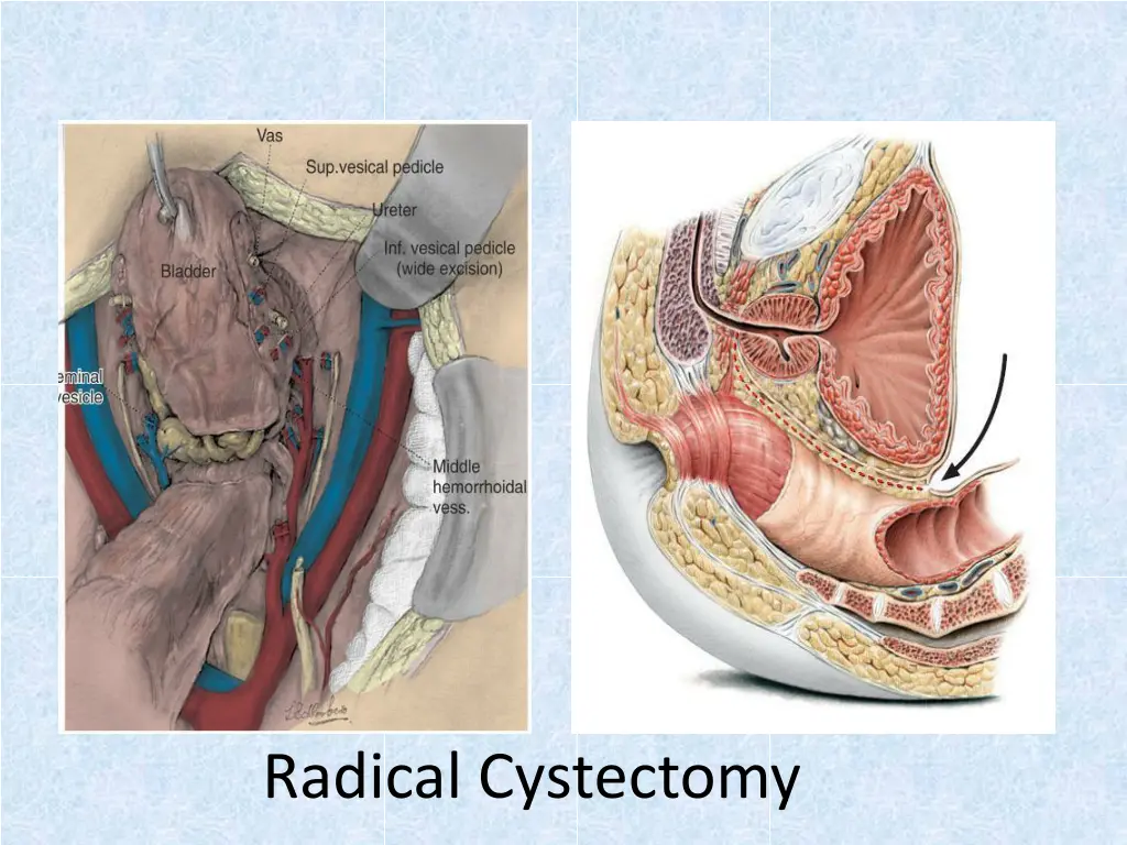 radical cystectomy