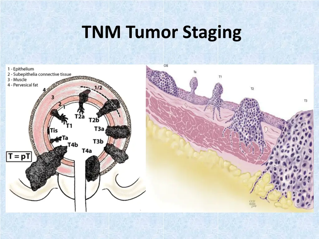 tnm tumor staging