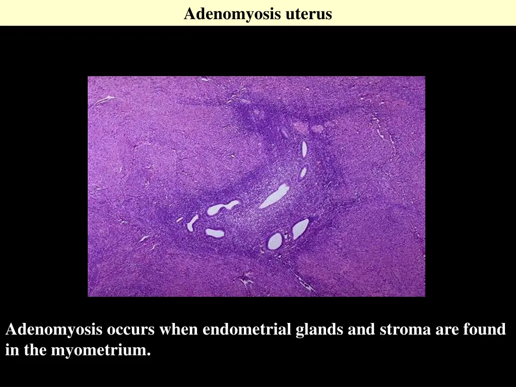 adenomyosis uterus 1