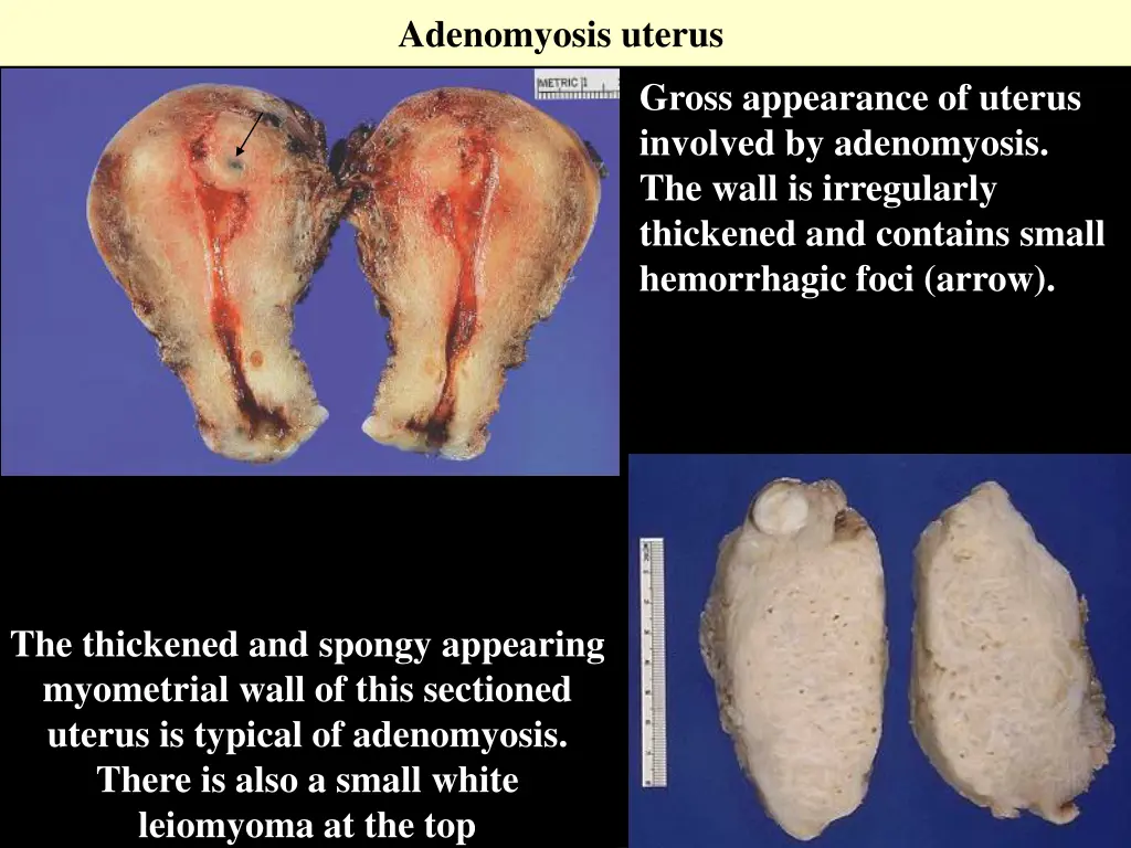 adenomyosis uterus