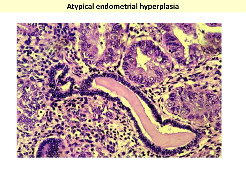 atypical endometrial hyperplasia