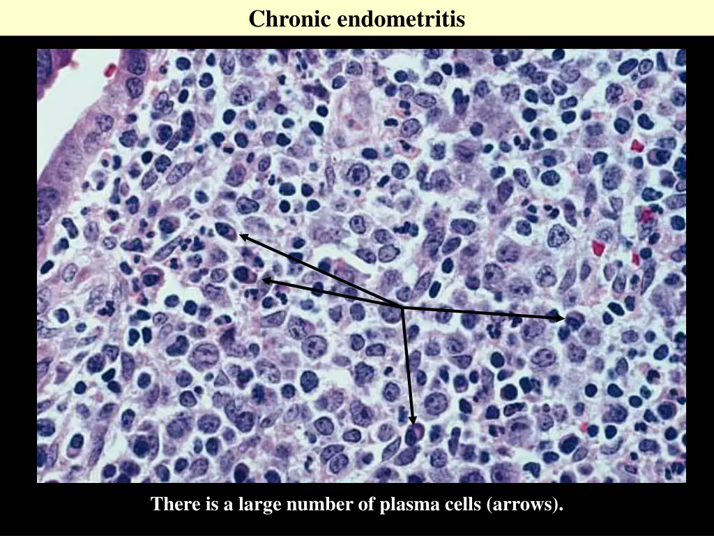 chronic endometritis