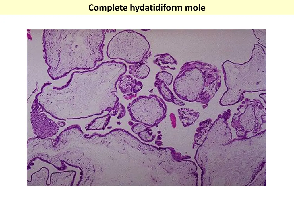 complete hydatidiform mole 1