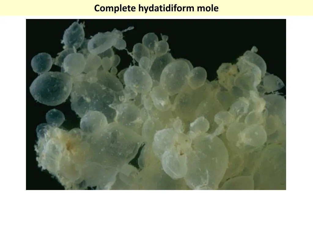 complete hydatidiform mole