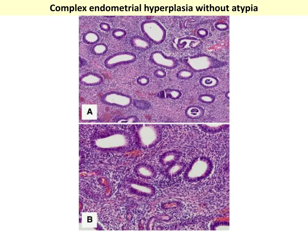 complex endometrial hyperplasia without atypia