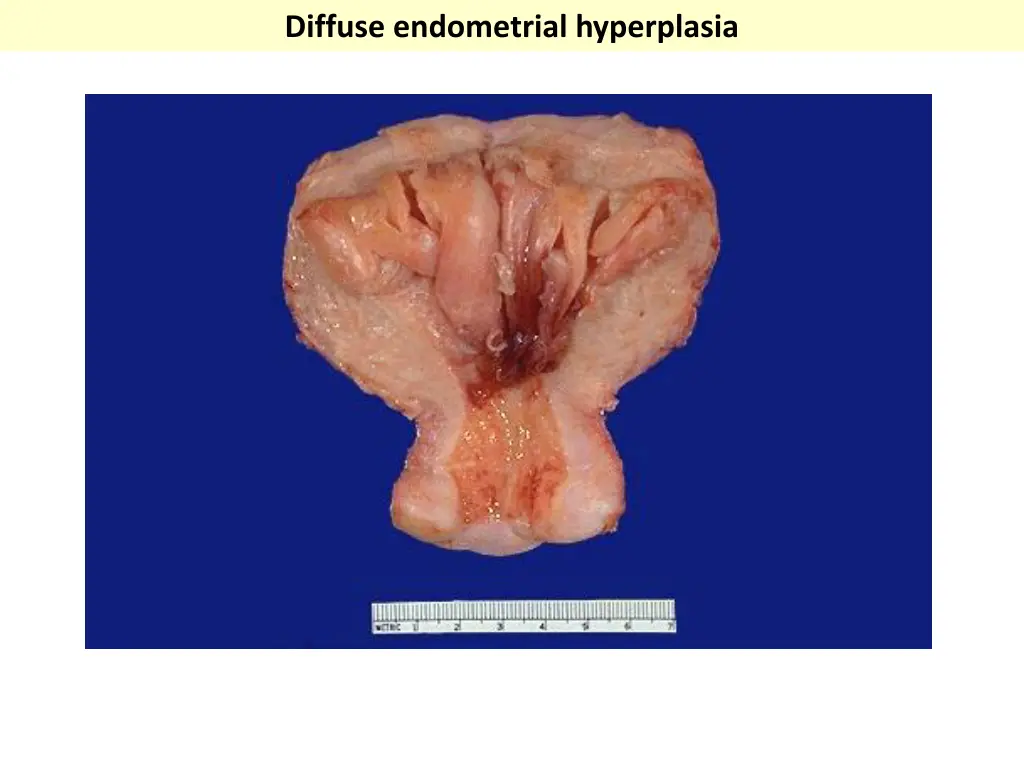 diffuse endometrial hyperplasia