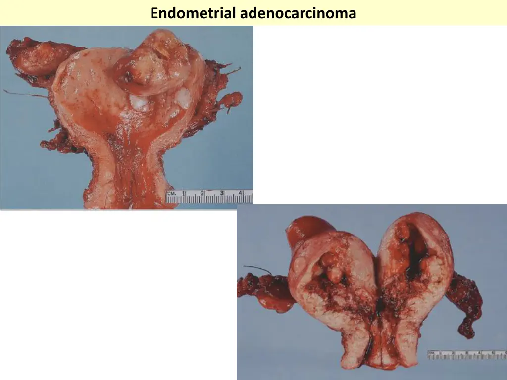 endometrial adenocarcinoma