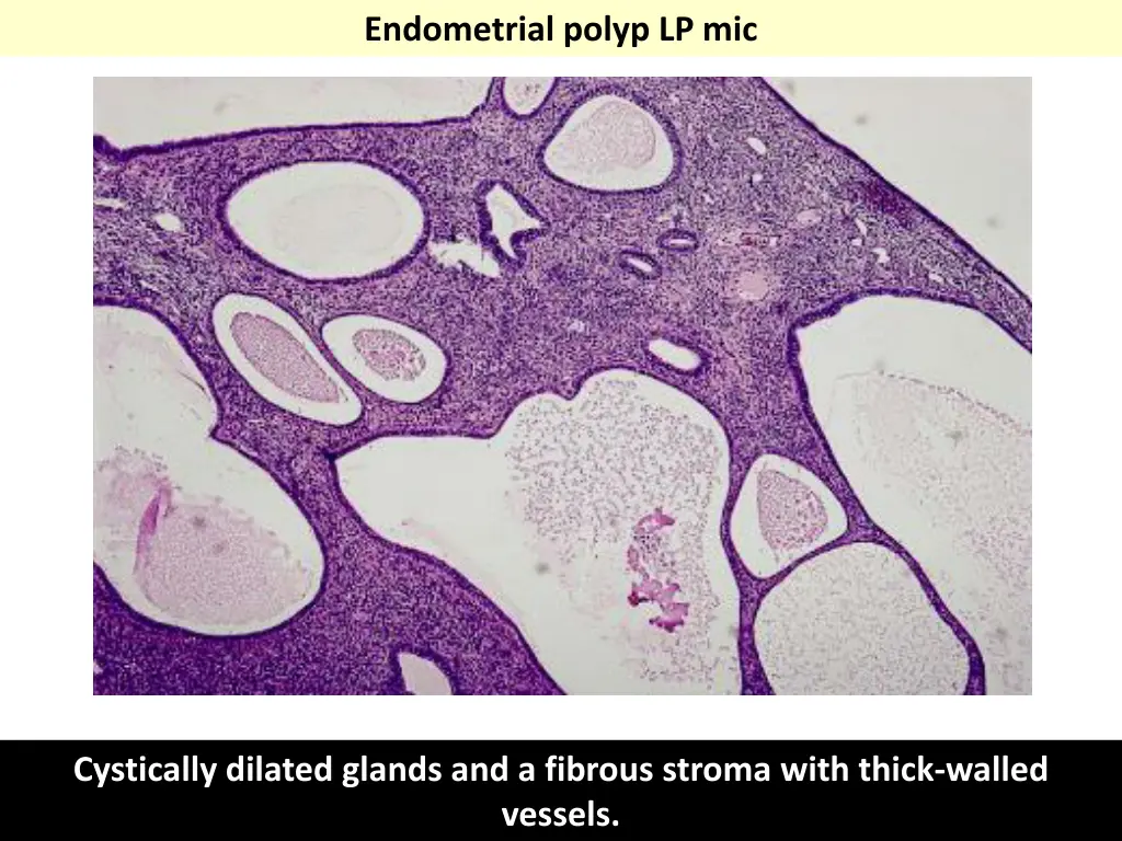 endometrial polyp lp mic