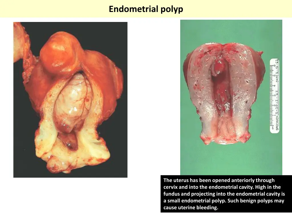 endometrial polyp